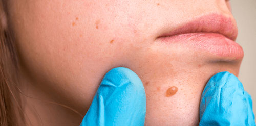 Benign tumor & Jaw Cyst Surgery in Nagpur