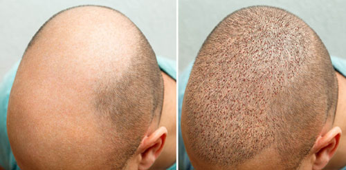 Hair Transplant in Nagpur