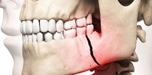 Facial and Jaw Fracture Plastic surgery in Nagpur
