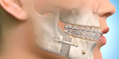 Facial Deformity (Orthognathic) Surgery in Nagpur